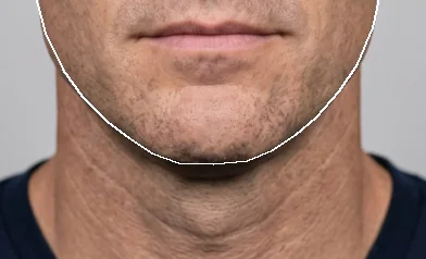 Synthetic face, lower half, chin filler visualization: 3 months, low, +1.2 mm forward