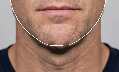 Synthetic face, lower half, chin filler visualization: Right after, +6.7 mm forward