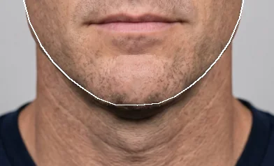 Synthetic face, lower half, chin filler visualization: 2 weeks, +4.2 mm forward