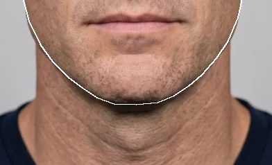 Synthetic face, lower half, chin filler visualization: Before