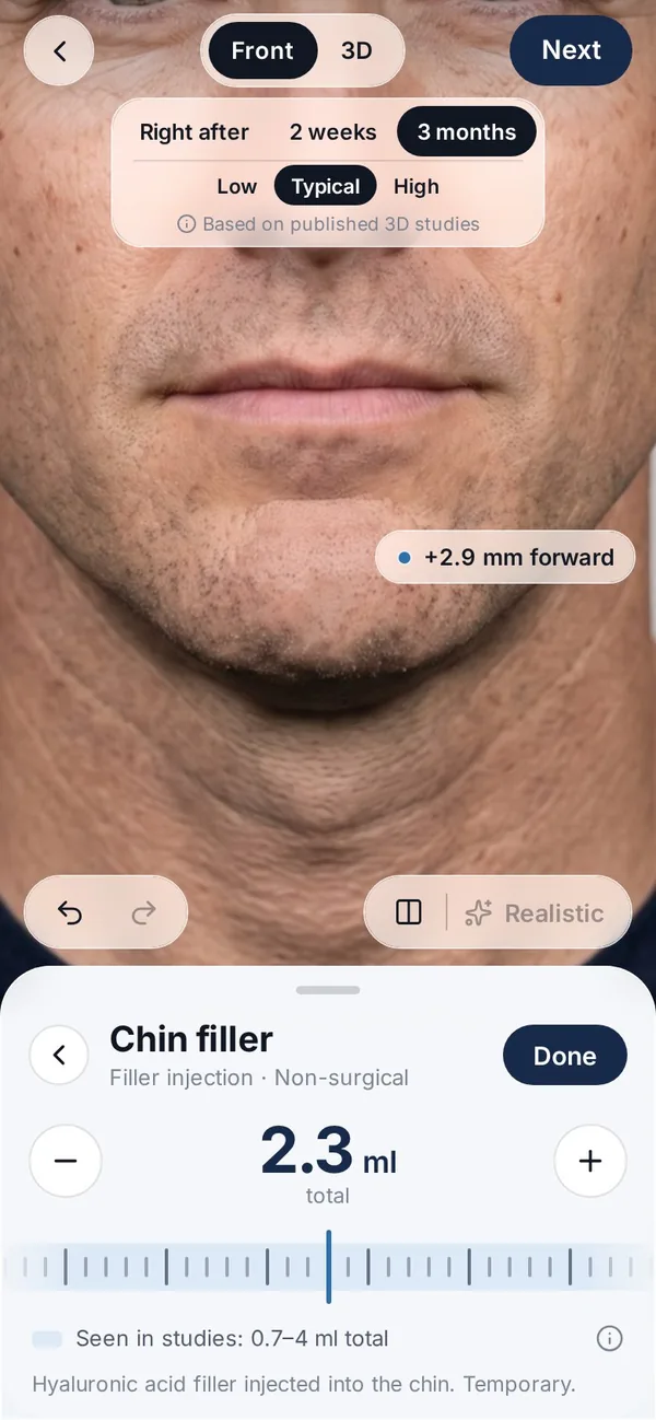Veylo app screen with a synthetic face: Filler over time (in testing)